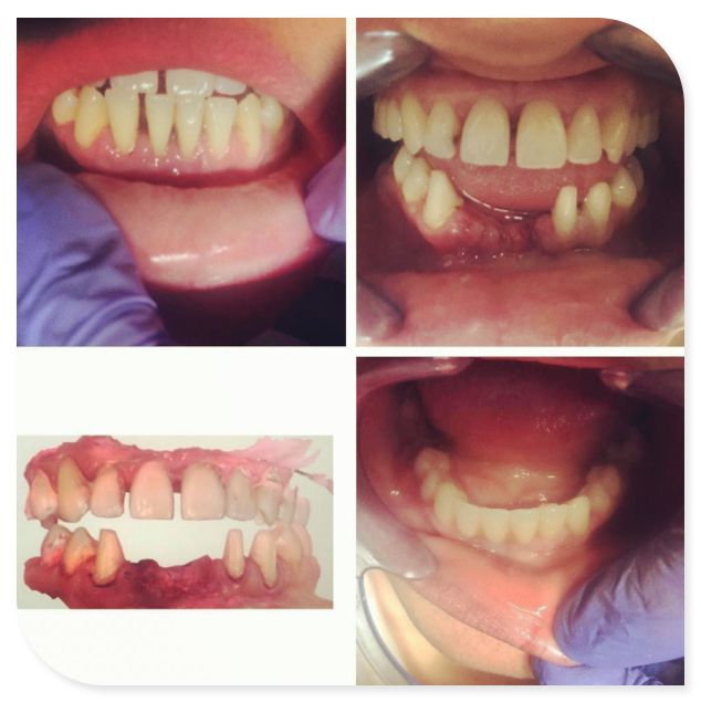 Safety of Zirconia Dental Crowns